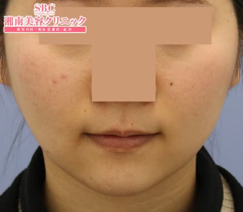 【女性・輪郭】美ボディ脂肪吸引_aftar