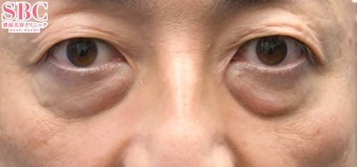 【目元】目の下の切らないクマ・たるみ（ふくらみ）取り、ナチュラル脂肪注射コンデンスリッチ、ナチュラル脂肪注射ナノリッチ_before