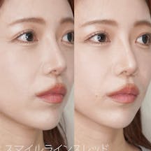 【女性・ほうれい線】スマイルラインスレッド_before_aftar