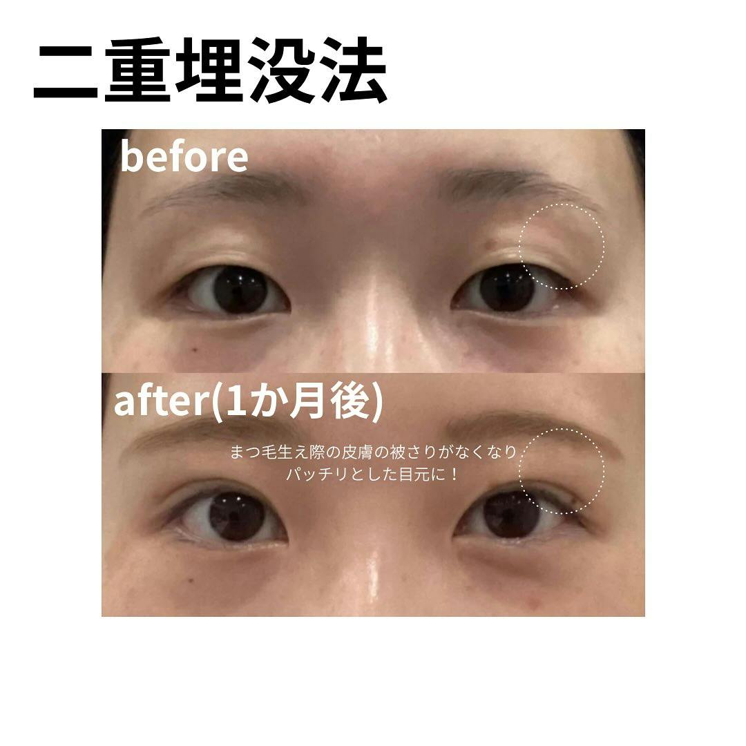 【女性・目元】二重埋没法_before_aftar
