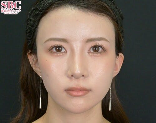 【女性・鼻】小鼻縮小（内側法＋締め付け縫合）_aftar