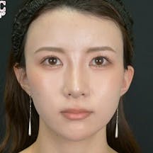 【女性・鼻】小鼻縮小(内側法+締め付け縫合)_aftar