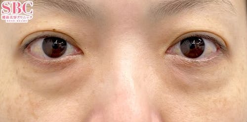 【40代女性・目元】目の下の切らないクマ・たるみ（ふくらみ）取り、ナチュラル脂肪注射ナノリッチ、ナチュラル脂肪注射コンデンスリッチ_before