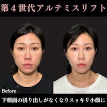 【30代女性・顔】アルテミスリフト+ エラボトックス_before_aftar