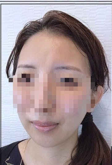 SSCビューティークリニックで傷跡修正アートメイクを受けたkoumeさんの写真