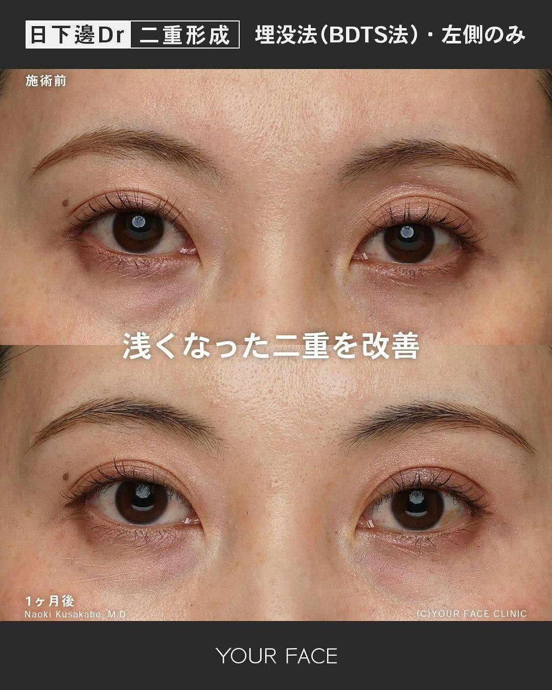 【女性・目元】埋没法（BDTS法）_before_aftar