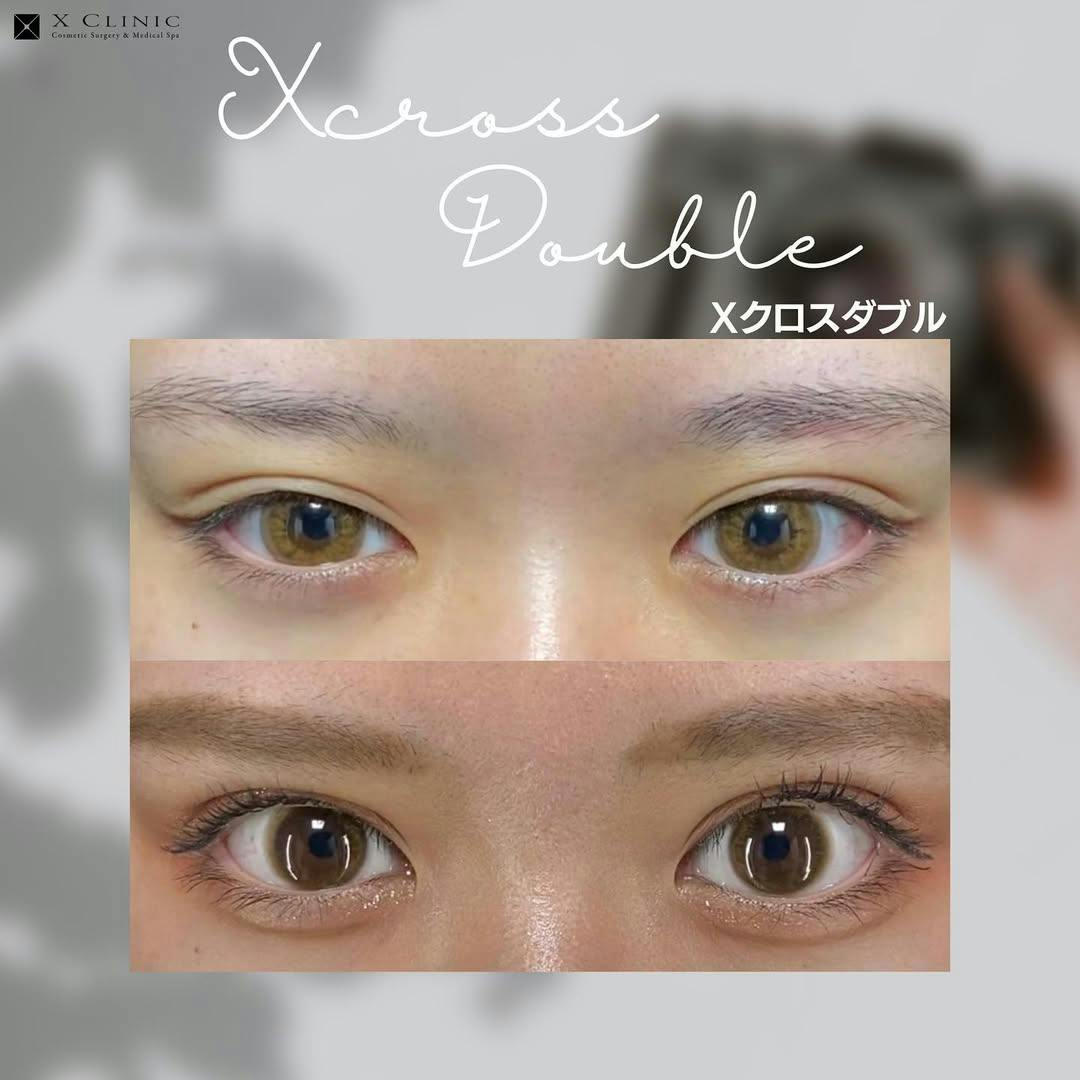 【女性・目元】Xクロスダブル_before_aftar
