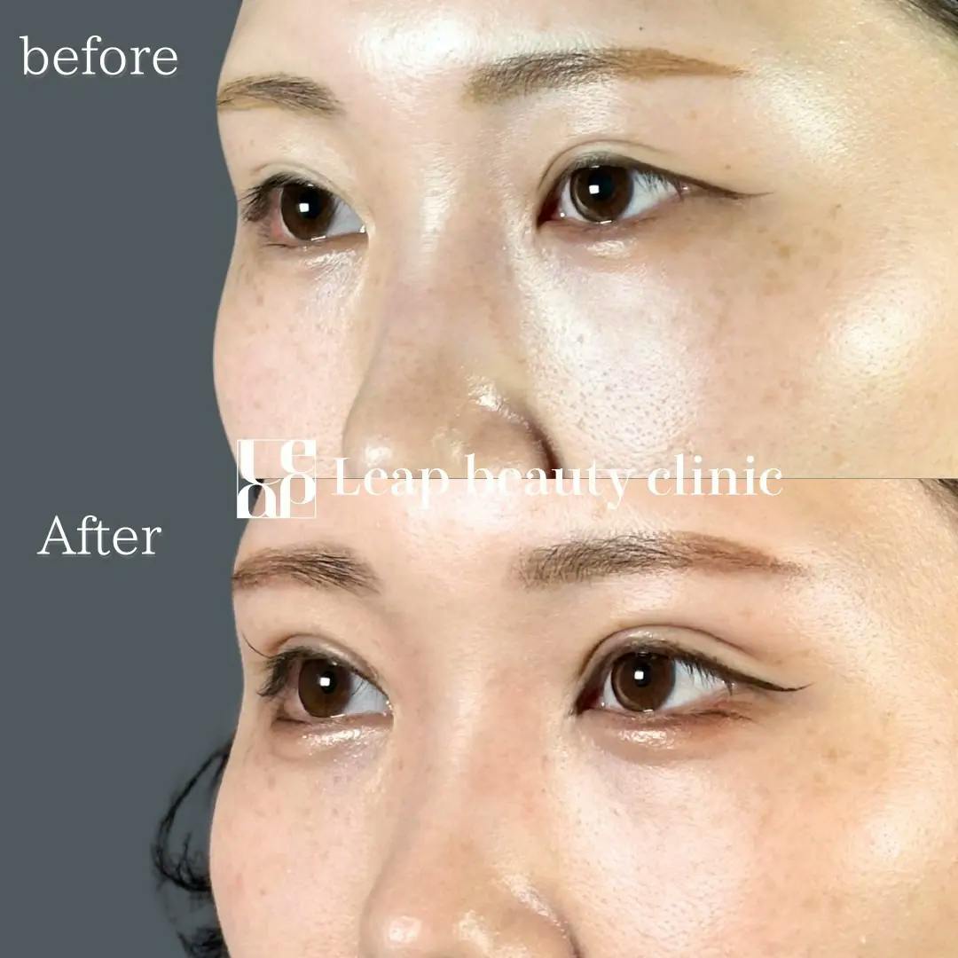【20代女性・目元】二重全切開_before_aftar