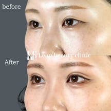 【20代女性・目元】二重全切開_before_aftar