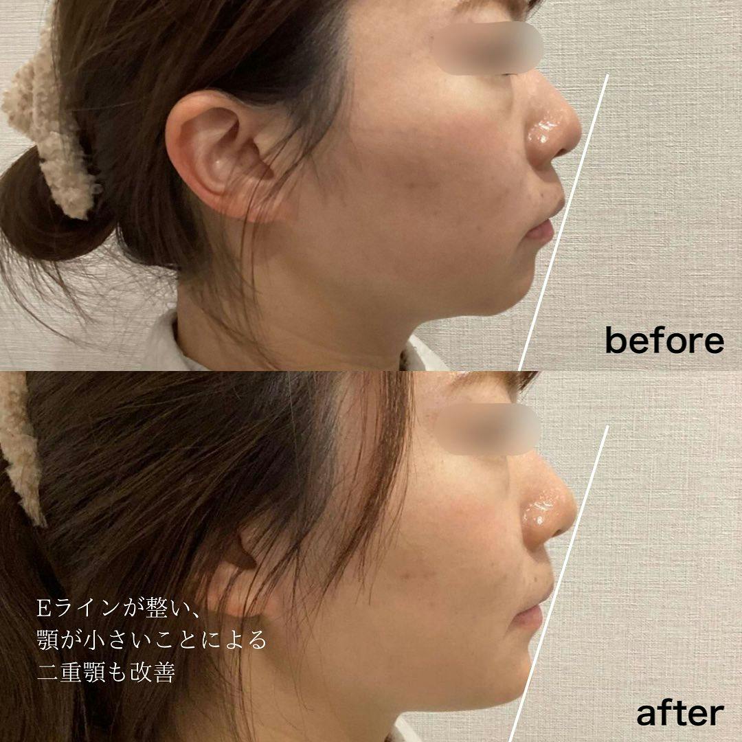 【女性・顎】ヒアルロン酸_before_aftar