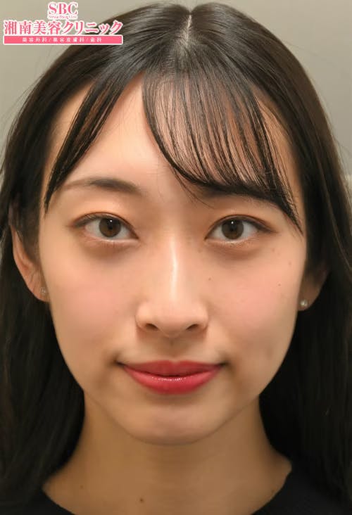 【女性・目元】目の下の切らないクマ・たるみ（ふくらみ）取り ナチュラル脂肪注射コンデンスリッチ ナチュラル脂肪注射ナノリッチ_after