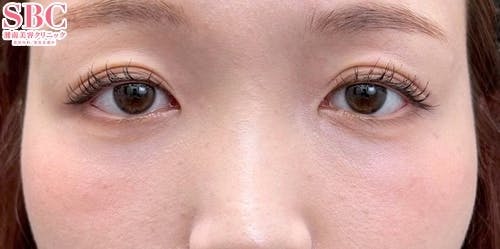 【30代女性・目元】裏ハムラ法、ナチュラル脂肪注射ナノリッチ_after