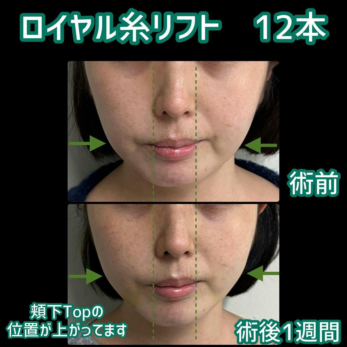 【女性・輪郭】ロイヤル糸リフト_before_aftar