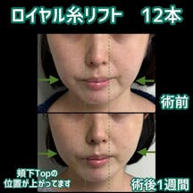 【女性・輪郭】ロイヤル糸リフト_before_aftar