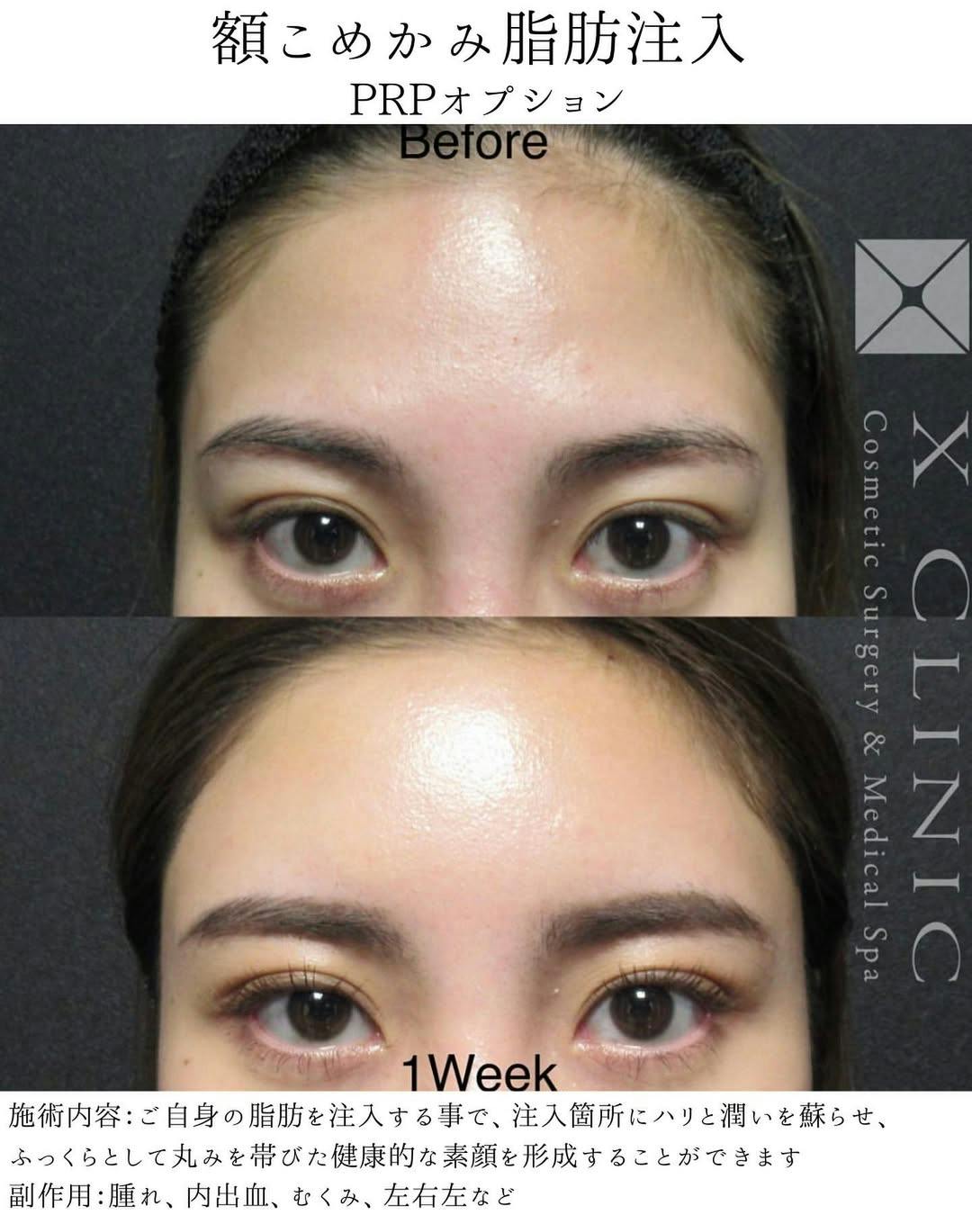 【女性・額】額こめかみ脂肪注入ト_before_aftar