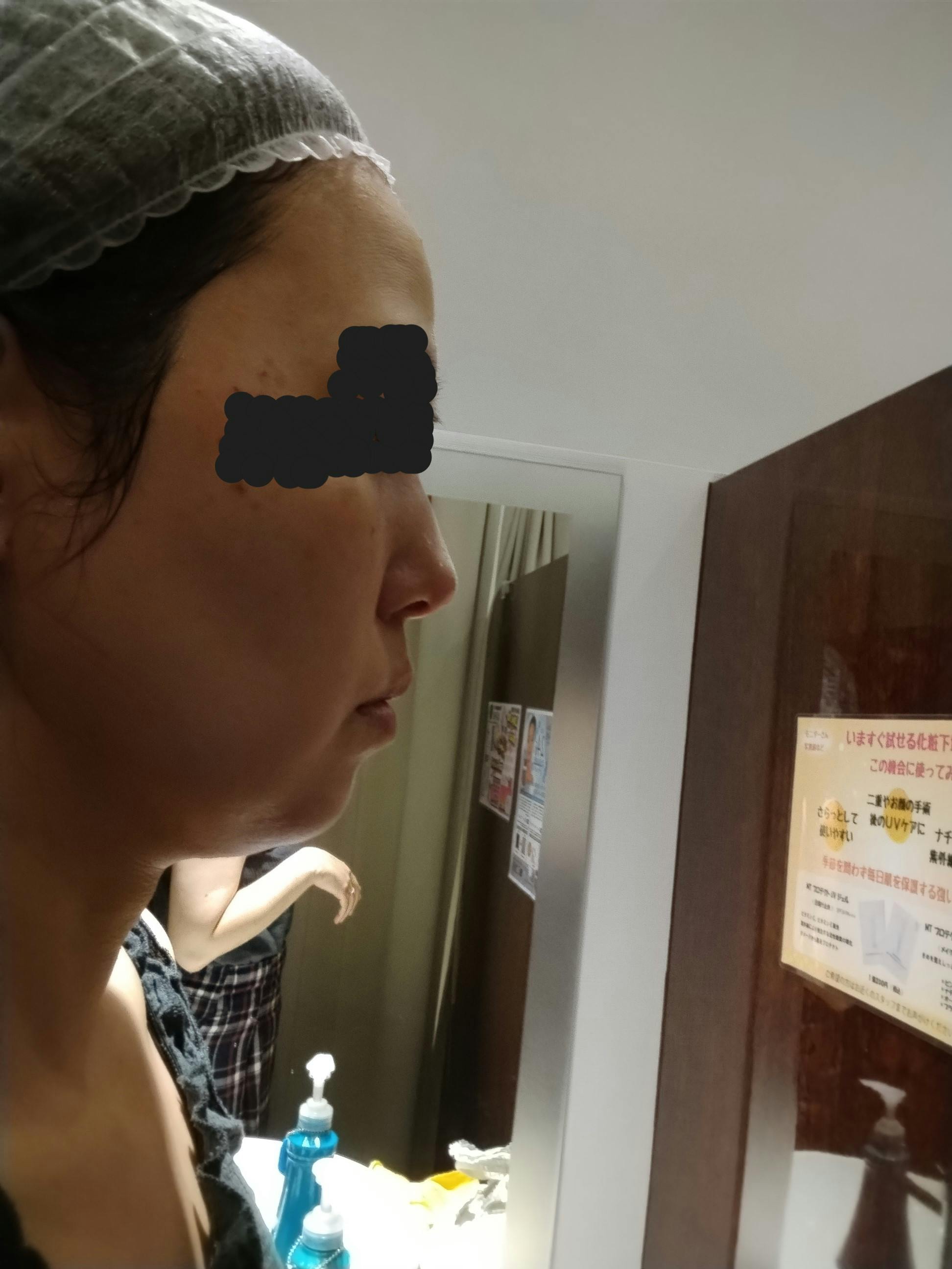 湘南美容クリニック 町田院でを受けたジャスミンさんの写真