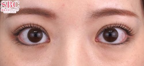 【20代女性・目元】クイックコスメティーク・トリプルNeo_after