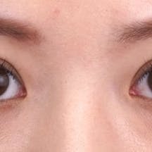 【20代女性・目元】クイックコスメティーク・トリプルNeo_after