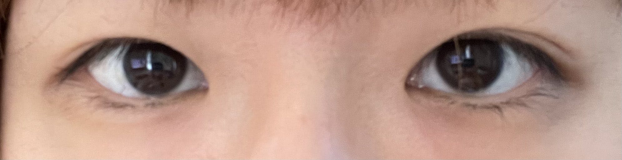 品川美容外科 名古屋院でスーパーナチュラル二重術切開法ロングを受けたのんさんの写真