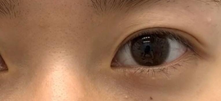 湘南美容クリニック 鹿児島院で二重埋没法:クイックコスメティーク・シングルNeoを受けたあやぱんさんの写真