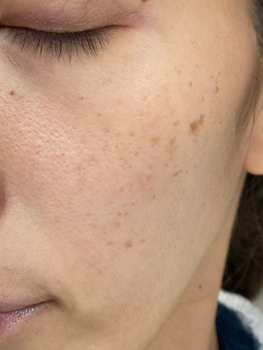 湘南美容クリニック 名古屋院で医療レーザー治療を受けたゆいさんの写真