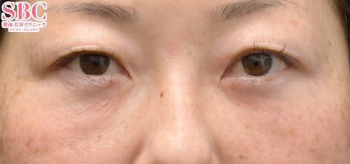 【女性・目元】目の下の切らないクマ・たるみ（ふくらみ）取り、ナチュラル脂肪注射コンデンスリッチ、ナチュラル脂肪注射ナノリッチ_aftar