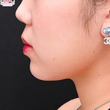 【20代女性・輪郭】美ボディ脂肪吸引_ after