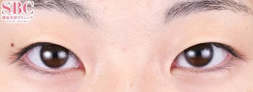 【女性・目元】クイックコスメティーク・ダブルNeo_before