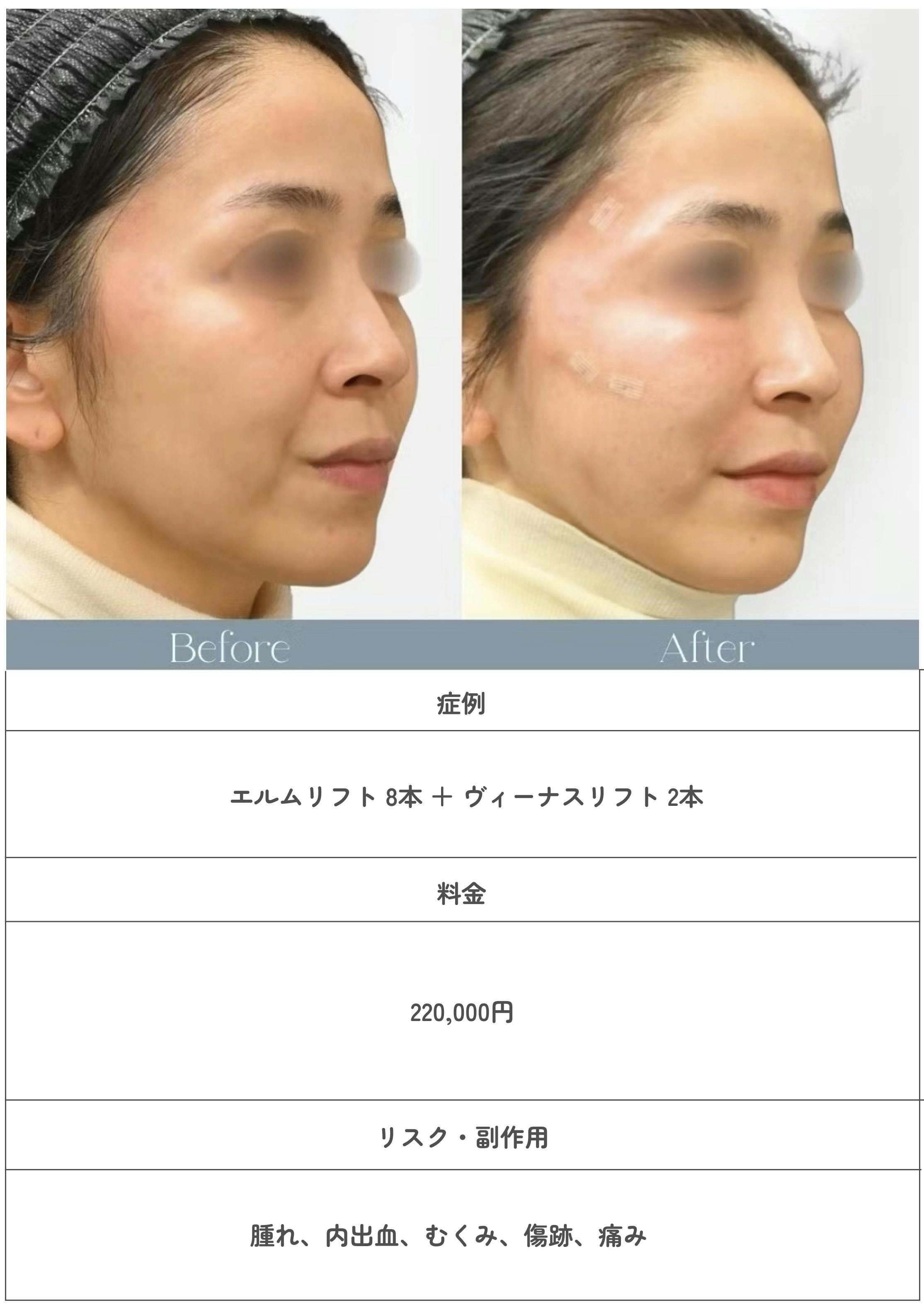 エルムクリニック糸リフト症例のビフォーアフター画像
