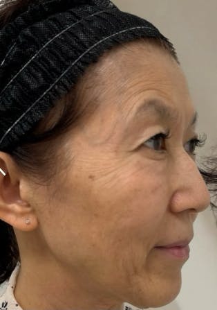 【50代女性・フェイスライン】アルテミスリフト_b1