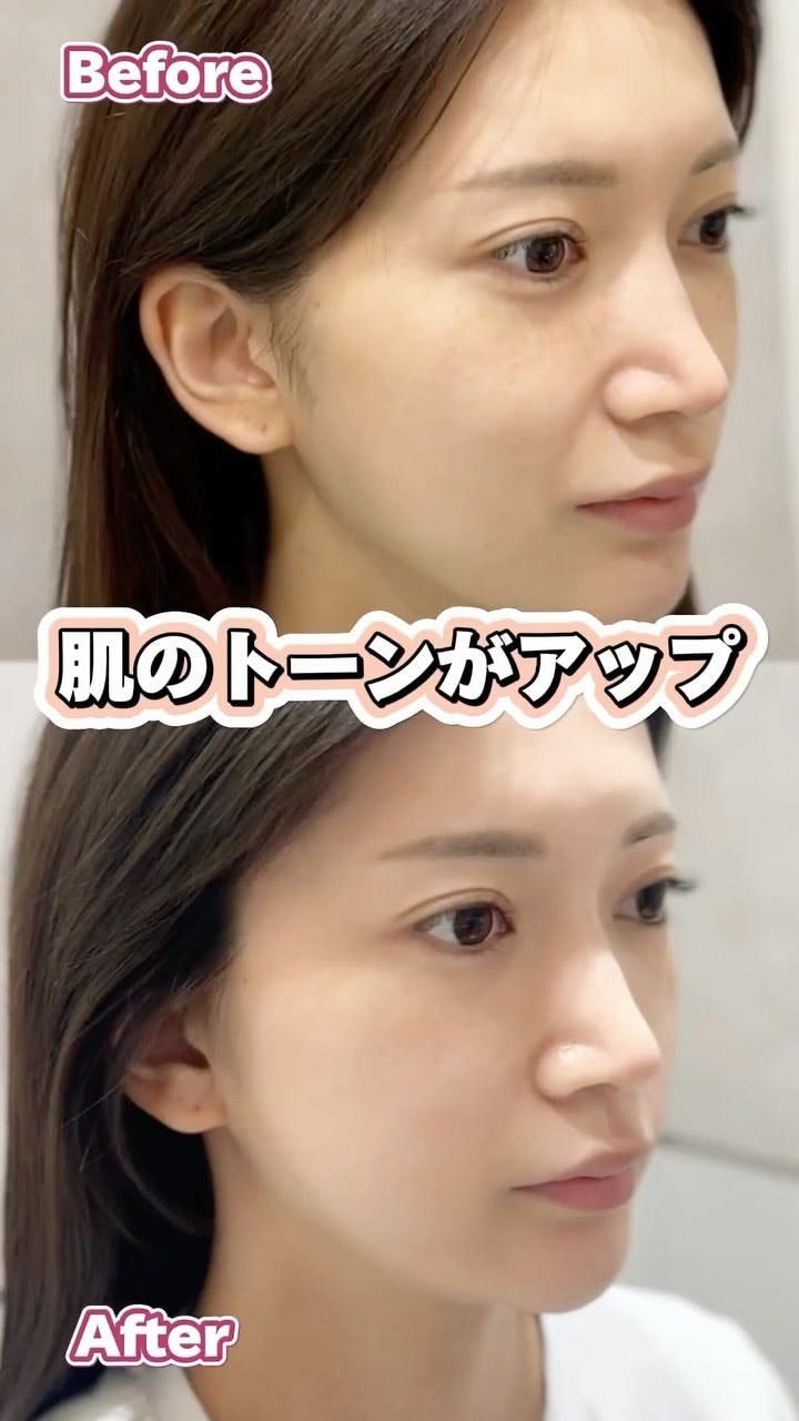 【女性・くすみ】ハイドラジェントル_before_aftar