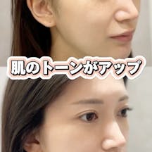 【女性・くすみ】ハイドラジェントル_before_aftar