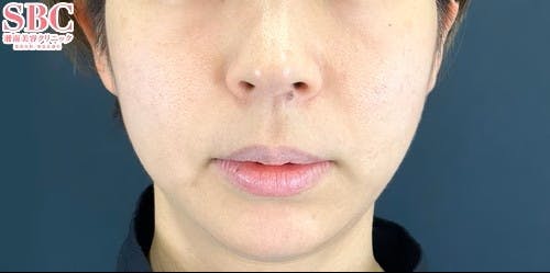 【女性・顔】VOV（ボブ）リフト、プリマリフト_before