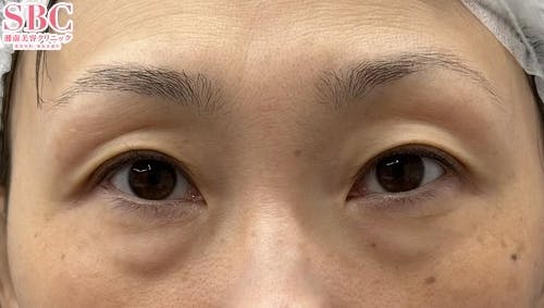 【40代女性・目元】目の下の切らないクマ・たるみ（ふくらみ）取り、ナチュラル脂肪注射_before