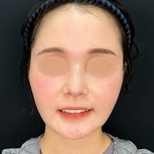 【女性・輪郭】美ボディ脂肪吸引_3month