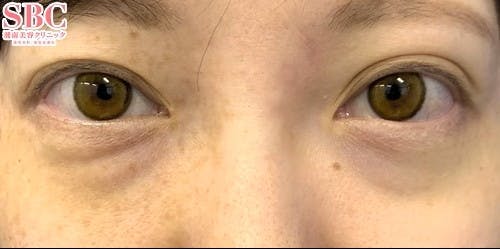 【女性・目元】目の下の切らないクマ・たるみ（ふくらみ）取り、ナチュラル脂肪注射コンデンスリッチ_before