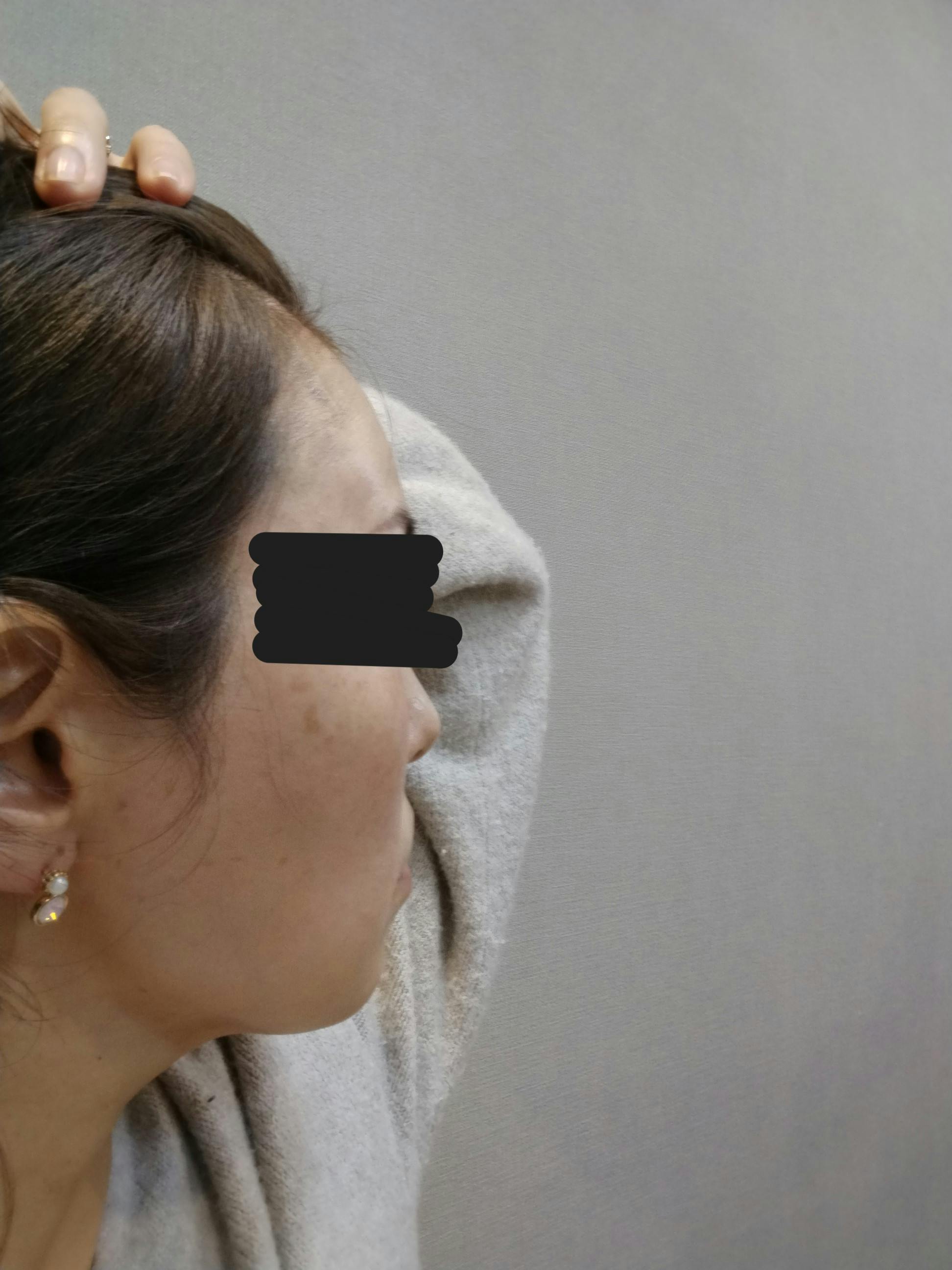 聖心美容クリニック 六本木院でPRP皮膚再生療法・PRP皮膚再生療法(首)を受けたジャスミンさんの写真