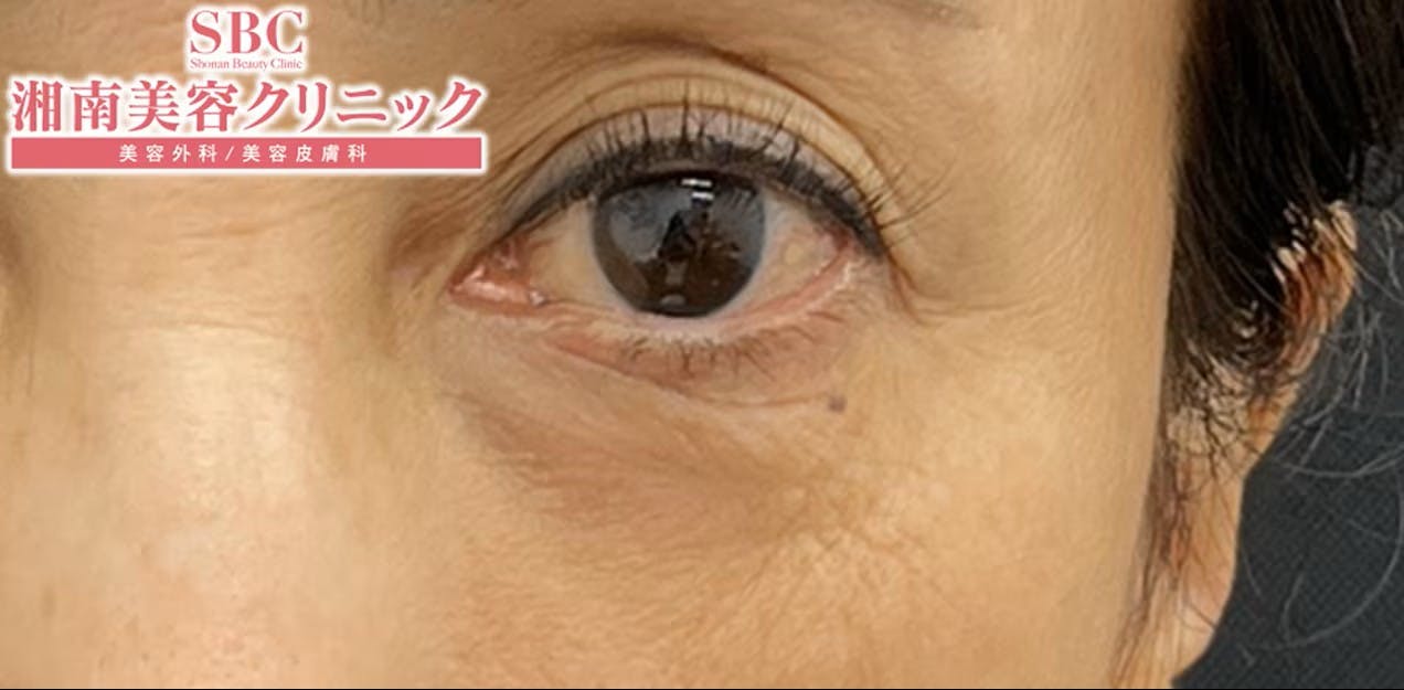 【60代女性・目元】アイバックリムーブ法、ナチュラル脂肪注射コンデンスリッチ、女優注射(R)~リジュラン＋ボトックス_before