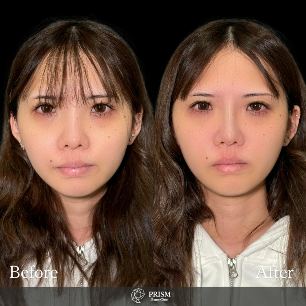 【20代女性・鼻】PRISMノーズスレッド_before_aftar