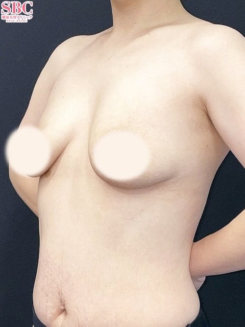 【女性・胸】豊胸インプラントバッグMESMO（メスモ）_before