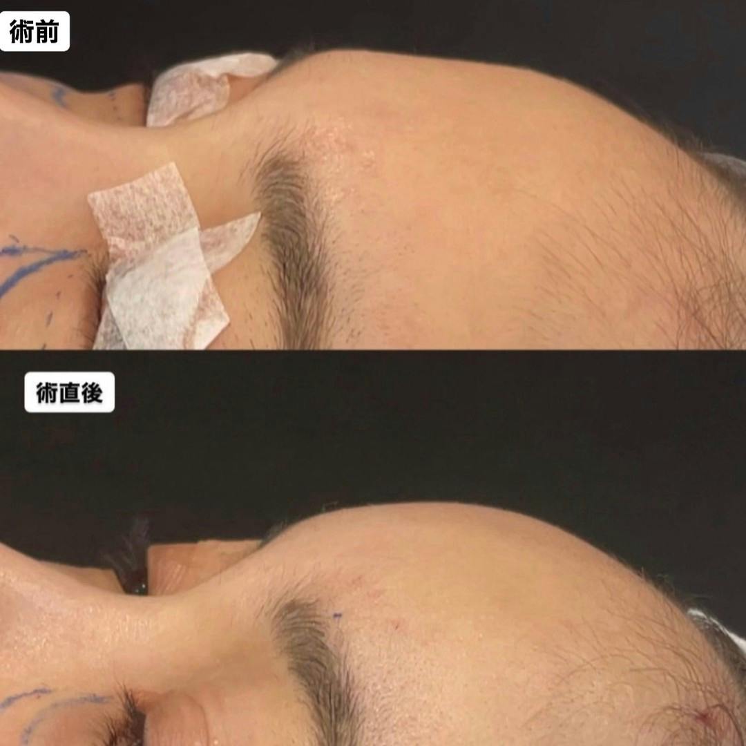 【女性・額】額・こめかみ脂肪注入(コンデンスリッチファット脂肪注入)_before_aftar
