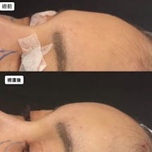 【女性・額】額・こめかみ脂肪注入(コンデンスリッチファット脂肪注入)_before_aftar