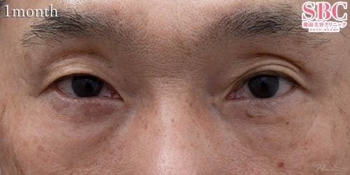 【50代男性・目元】裏ハムラ法、SBCプレミアムPRP皮膚再生療法_after