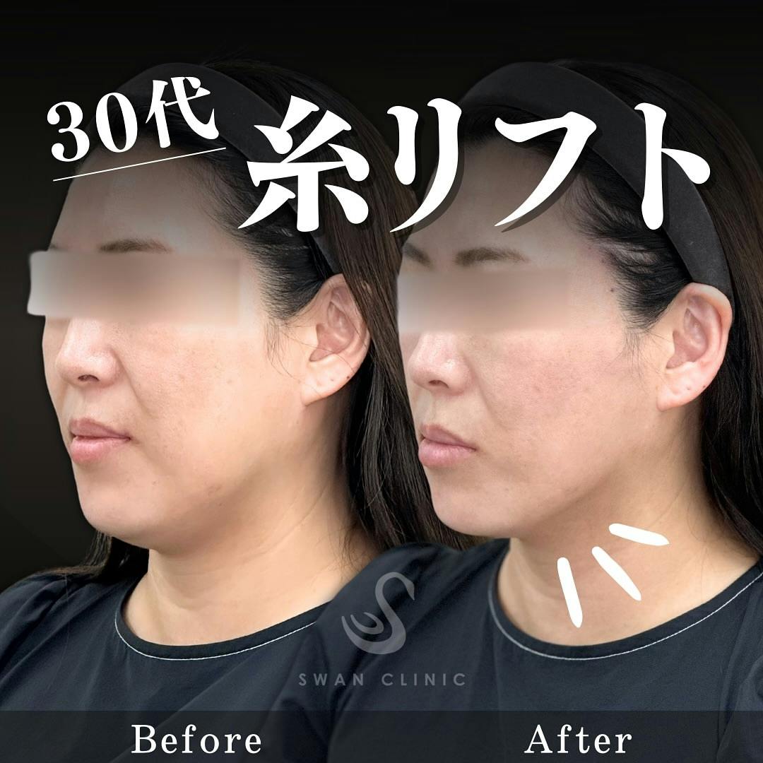 【30代女性・輪郭】下顔面の糸リフト 顎ヒアルロン酸注入 エラボトックス_before_aftar