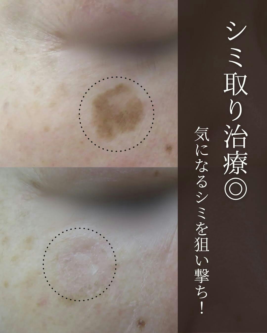 【シミ】Q スイッチYAGレーザー_before_aftar