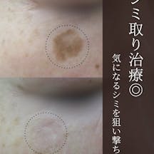 【シミ】Q スイッチYAGレーザー_before_aftar