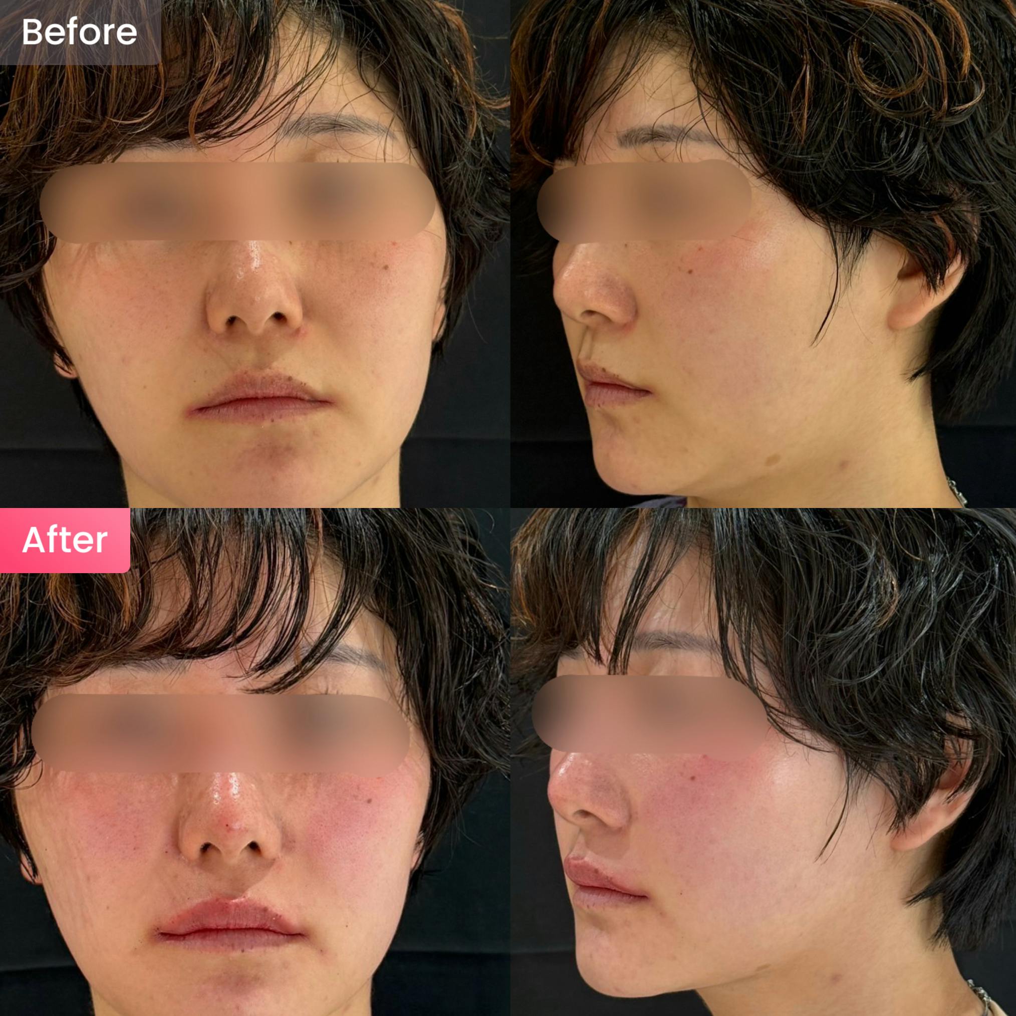 ヒアルロン酸_before_after