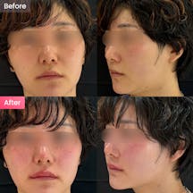 ヒアルロン酸_before_after