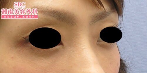 【女性・目元】目の下の切らないクマ・たるみ（ふくらみ）取り・ナチュラル脂肪注射コンデンスリッチ・ナチュラル脂肪注射_aftar