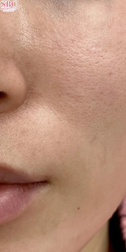 【女性・ほうれい線】ヒアルロン酸ジュビダームビスタ ウルトラプラスXC_before